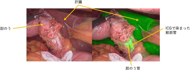 胆のう、肝臓、胆のう管、ICGで染まった総胆管を矢印で示した図
