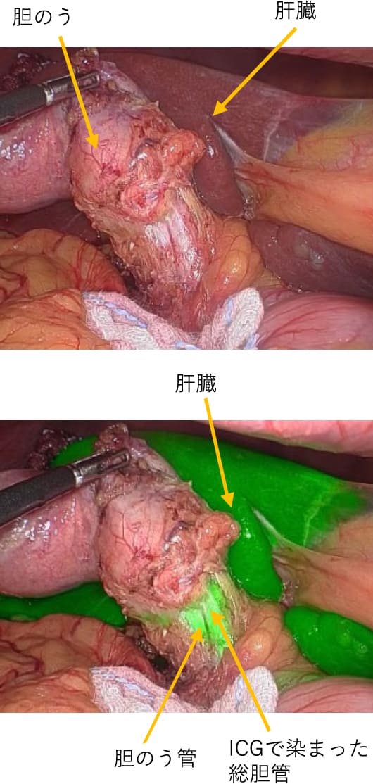 胆のう、肝臓、胆のう管、ICGで染まった総胆管を矢印で示した図