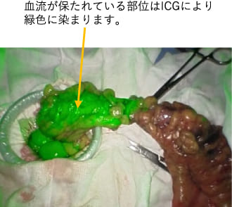 血流が保たれている部位はICGにより緑色に染まります。