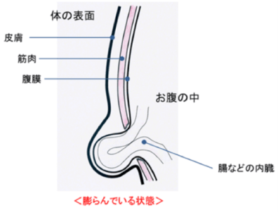 膨らんでいる状態