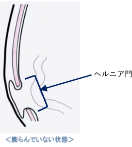 膨らんでいない状態