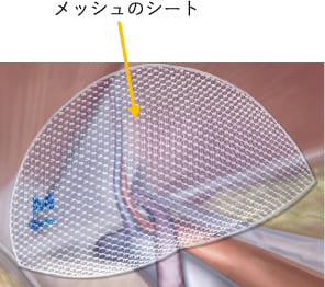 メッシュのシート