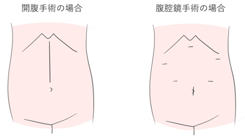 開腹手術の場合と腹腔鏡手術の場合