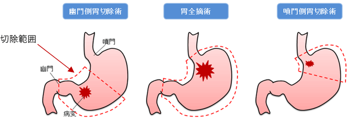 赤い点線で切除範囲を示した図